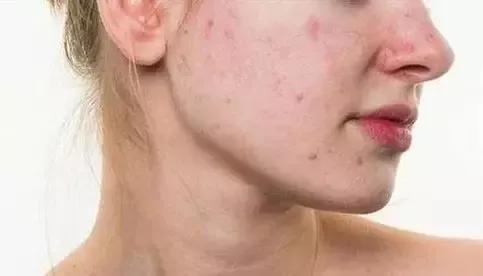 皮肤|换季时,如何护肤才安全有效?