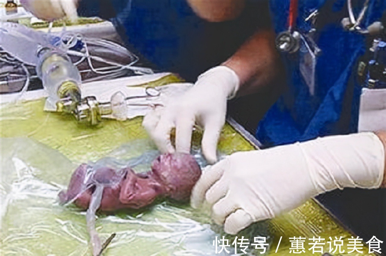 磨难|生命奇迹!“世界最小婴儿”出生仅25厘米,如今18岁的她怎样了
