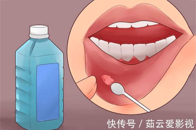 黏膜|医生提示:看似是小病,其实是癌前病变,这4种病,很少人放心上