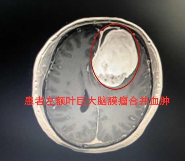 神经外科|莫名头痛头晕，小心脑瘤卒中发作