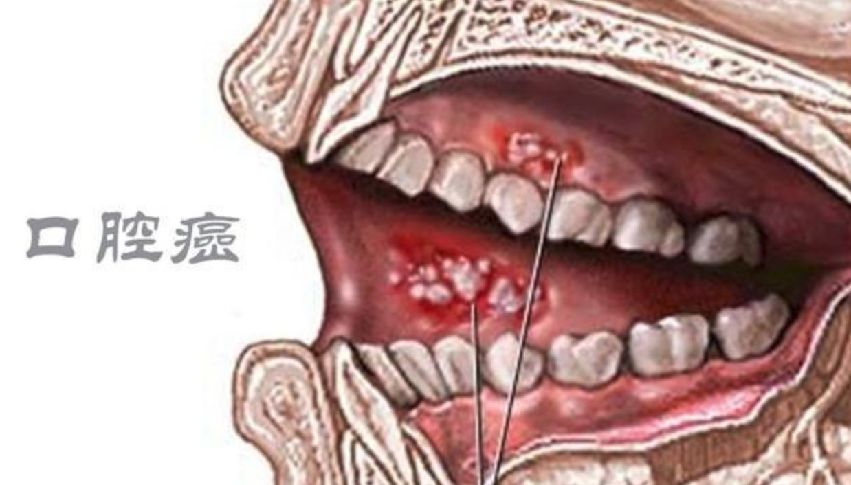 耳鼻喉|为什么会得口腔癌大多和这些习惯有关,希望你能改
