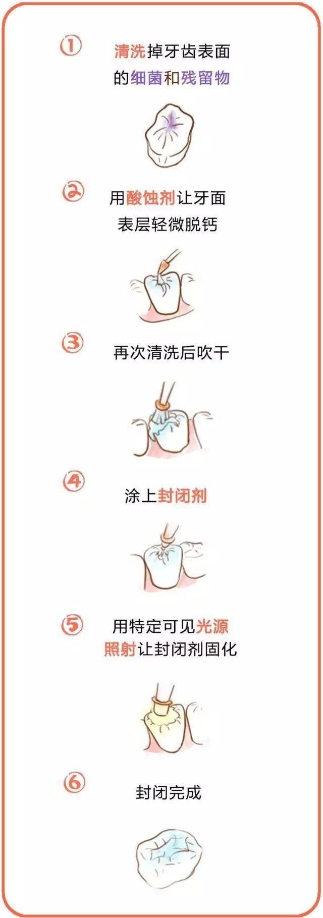 图文来源网络|涂氟、窝沟封闭——孩子牙齿的保护衣