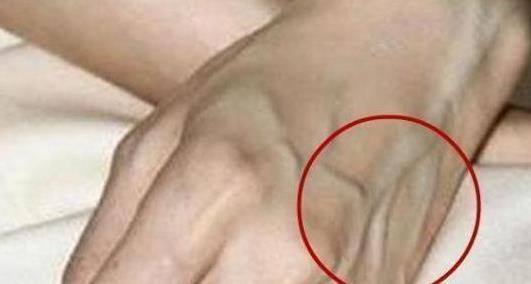 手上青筋越多,说明身体是好是坏青筋究竟是怎么回事