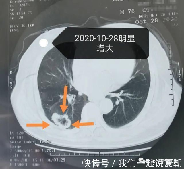 靶向治疗|肺癌的治疗要花多少钱?晚期肺癌还有必要治疗吗?