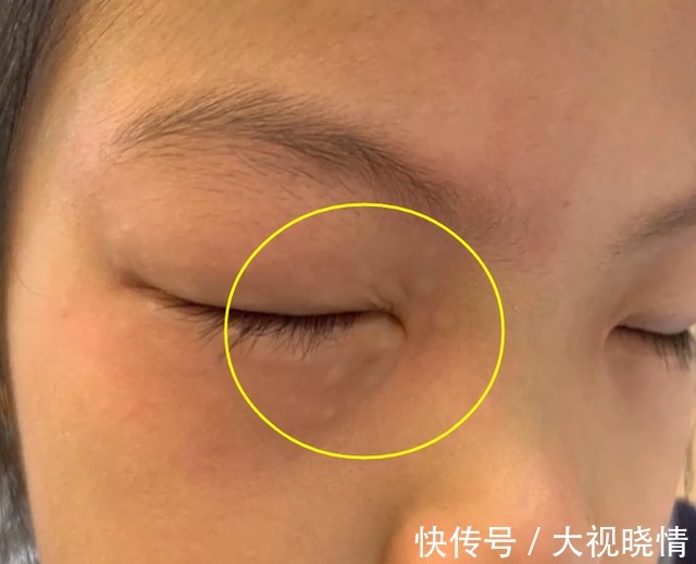 眼睛|怪事?宁波9岁女孩一做数学题眼睛四周就过敏,网友:我家也一样