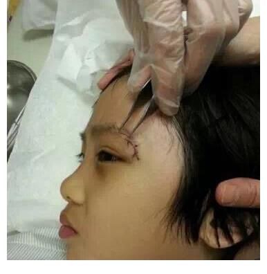 节目组|真被毁容了?12岁费曼眼角疤痕明显,视力受永久性伤害,这波亏了