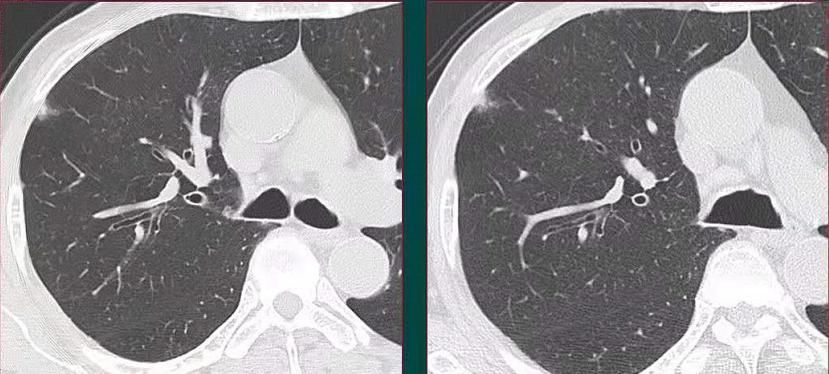 这类肺结节容易漏诊，错把肺癌当肺炎