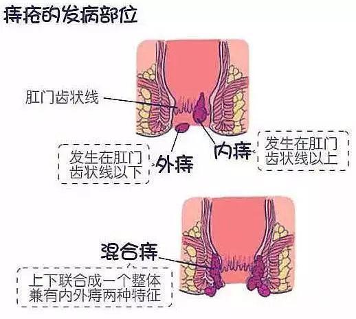慎入|盐水洗痔疮居然好了？没想到痔疮竟然也有弱点，8年混合痔有救了