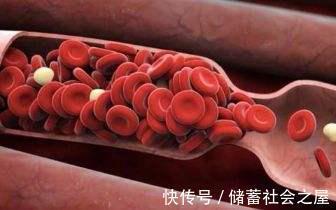 右脑|45岁男子深夜脑梗,不喝酒不抽烟,专家直言:1件事做的太频繁