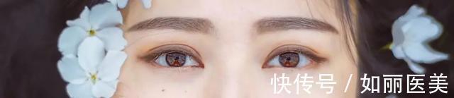 重睑 什么是割双眼皮呢?割双眼皮手术都包含哪些项目?你都了解吗