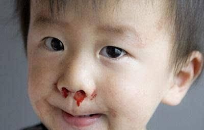 医生|4岁宝宝半夜突然流鼻血,送到医院后,医生的话让妈妈无法接受