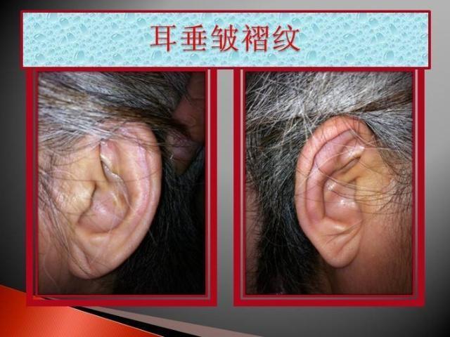 食物|经医院查出血脂较高后,注意少吃3类食物,多做4件事,血管不拥堵