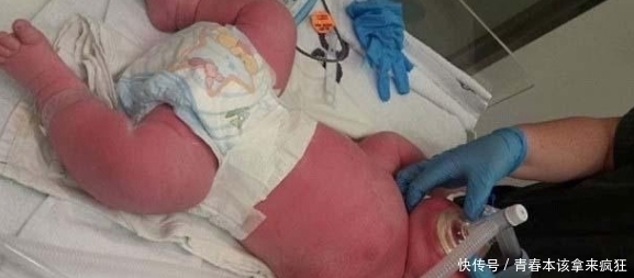 小家伙|小家伙在妈妈肚子里“撑裂”肚皮,医生吓坏差点拒绝接生