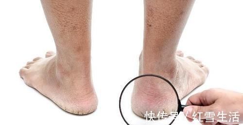 指甲盖|肝不好看手,肾不好看脚,你没有这些特征说明你的肝肾还算健康