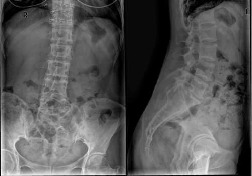 椎体|脊柱常见肿瘤及肿瘤样病变的几种影像学表现,你都见过吗?