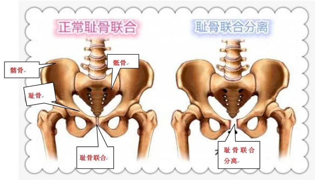 耻骨|【产后康复】产后要健康，产康来护航——来我中心四楼产后修复科！