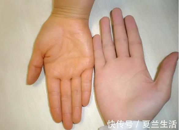 肝掌|肝好不好，全“写”在手上，手上若无3种“表现”，肝脏很健康