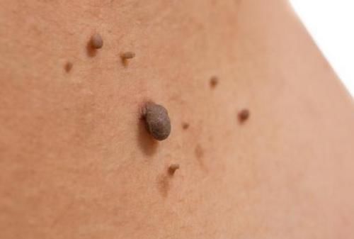 睡眠时间|脖子和腋下的“小肉粒”是什么?可以用手拉吗?