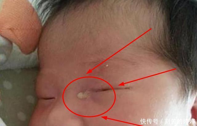 6个月女童泪流不止，医生将针扎入眼角，流出的液体让妈妈吓坏了