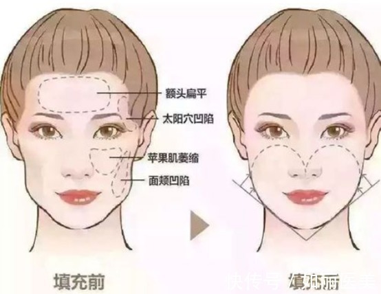 填充 自体脂肪填充面部安全吗,术后能维持多久呢?