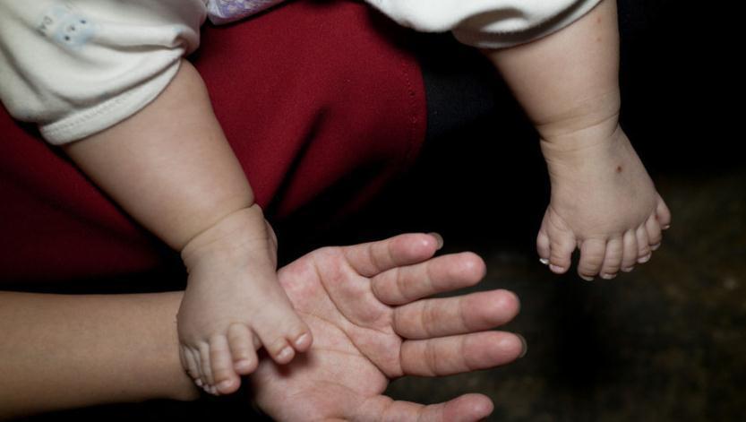 多指症|3个月大的男婴为何长出31根指头?得知原因后母亲崩溃痛哭