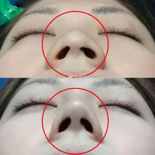 鼻综合中鼻头鼻翼缩小术的价格是多少?术后有哪些后遗症?