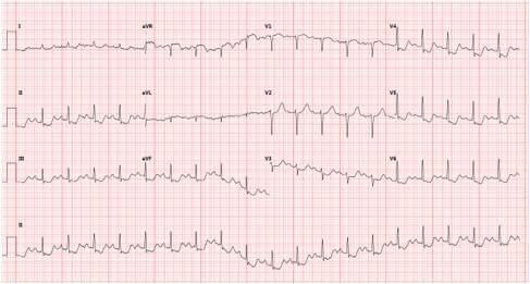  痉挛|“医生，我胸痛2天、血压185/92 mmHg！怎么回事？”