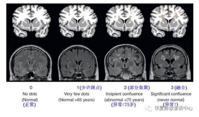 MR cavity infarction, demyelination, perivascular space, ischemic foci... How should the imaging report be written correctly?