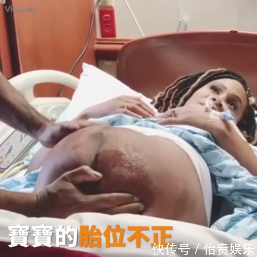 枕前位|医生徒手帮孕妈转胎位，当妈真的不容易，网友这肚皮都薄成纸了