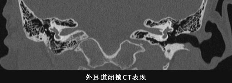 诊疗|耳整形专家带你了解外耳道闭锁