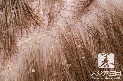 头皮有结痂怎么治疗