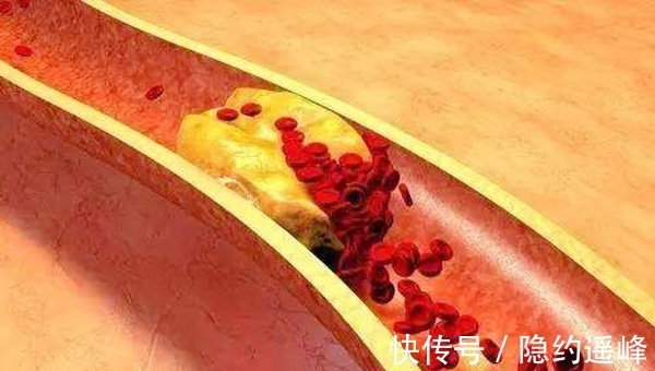 超标|甘油三酯超标,身体可能有四种迹象,做对了也能轻松降血脂