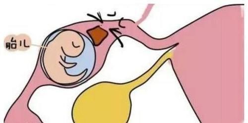 有一个姑娘|为什么越来越多的女性出现宫外孕这种行为女孩子要特别重视