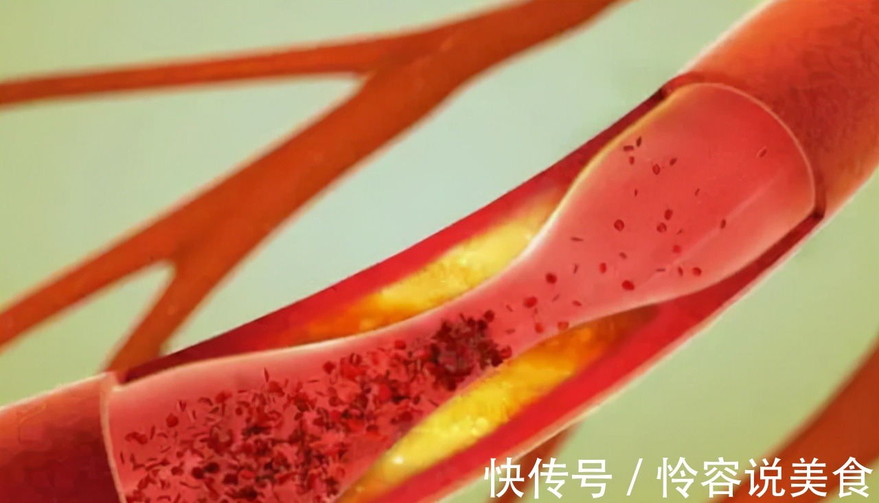 冠状动脉|多走路能降血脂医生提醒日常多吃这4物,或比走路效果好