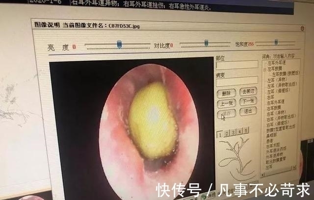 家长们|8岁男孩耳朵疼痛难忍,父母带孩子去检查,取出的东西让爸妈崩溃
