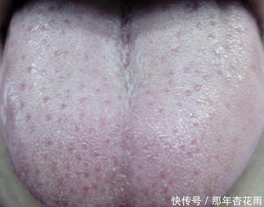 脾胃|老是放屁估计是脾虚了,1个小方子,健脾养胃,湿气不来扰