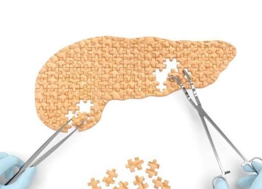 胆结石|“胰腺癌”容易发生在这6类人身上,若出现这3个特征,需警惕