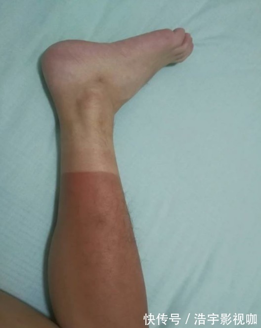 马路天使|男子晒“渐变色”皮肤,网友不服,一场“比惨”大赛开始了