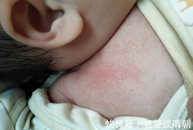 红疹子|想给宝宝拍美美的满月照?先别急,看完这3个危害再做决定