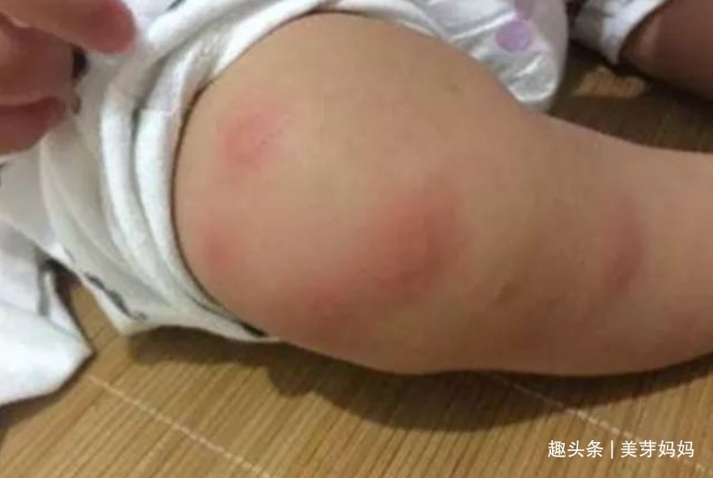 止痒|宝宝被蚊子叮咬后,第一步不是帮娃止痒,很多家长都做错了