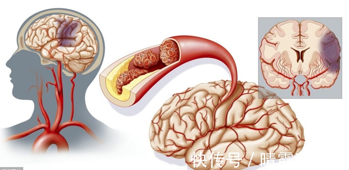 脂肪肝|高血脂降不下来？1简单小招，不到1个月，血脂就降了、血管干净