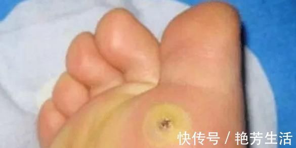 疾病|脚上长“茧子”和疾病有关?若脚上出现4种茧子,一定要留意了!