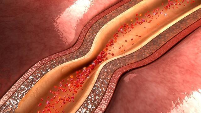 高血脂|手脚出现2种“异常”，十有八九是血脂高了，三件事尽早远离！