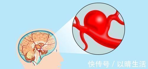 泡水|脑供血不足，哪些中药泡水喝能够改善有几种中药是不错的选择