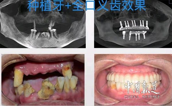 ct|衡南县人民医院引进新口腔CT（CBCT）与种植牙技术