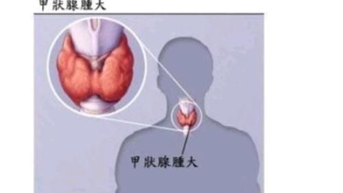 十字花科|患有甲状腺结节的人,不能吃花菜?看情况,这2种食物确实要少碰