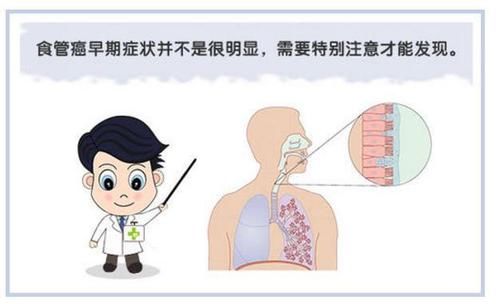 抓住|食道癌早期的4个表现，如果你能够及时抓住，或许能够避过一劫！