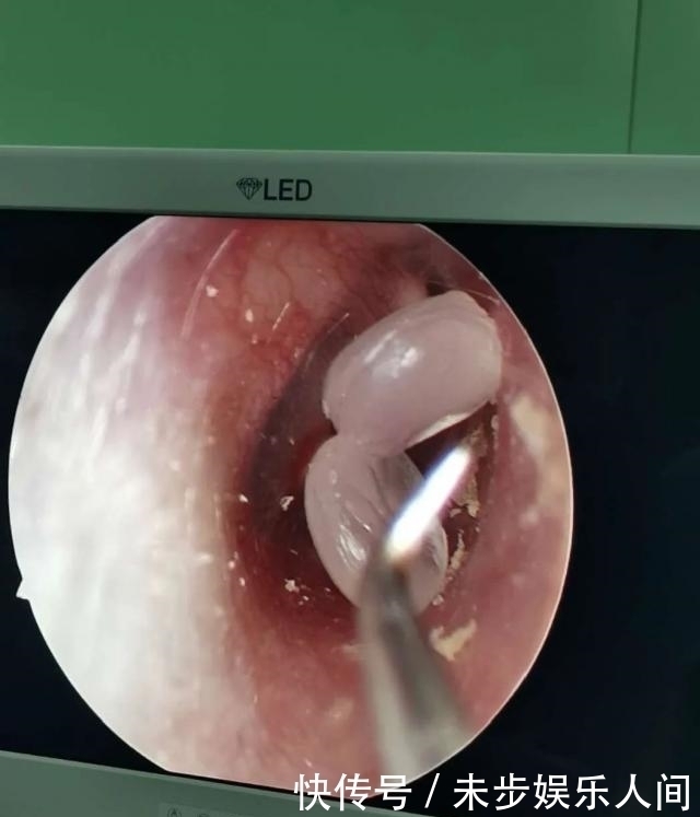 5岁男孩竟往耳朵里塞这个!全麻后才取出,医生紧急提醒