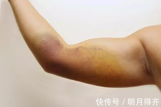 癌症|腰痛、贫血、抵抗力下降...你还不在意小心被这种癌症“盯”上