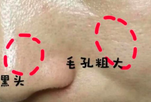 毛孔粗大分型